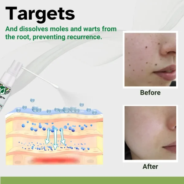 AEXZR™ Herbal Moles & Warts Removal Spray