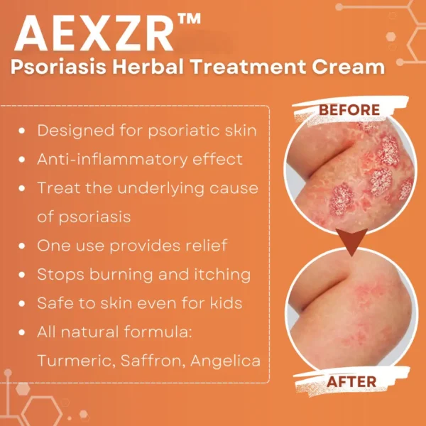 AEXZR™ Psoriasis Herbal Treatment Cream