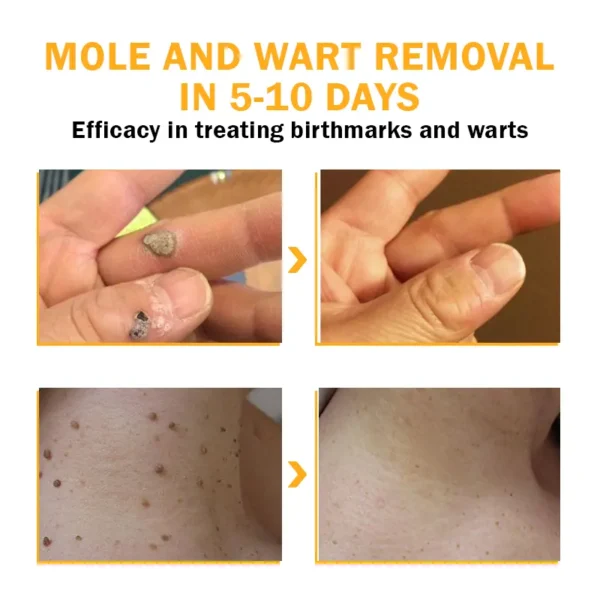 Biancat™ FlawlessFix Mole & Wart Removal Cream