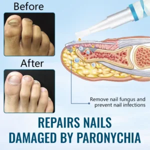 Ceoerty™ Anti-Paronychia Nail Repairing Gel