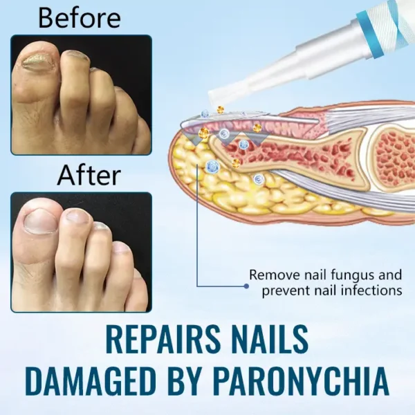 Ceoerty™ Anti-Paronychia Nail Repairing Gel