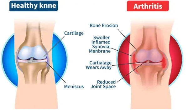 FLYCARE™ Bee Venom Advanced Joint and Bone Therapy Cream