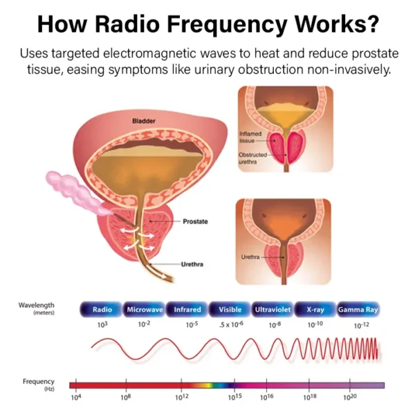 Oveallgo™ ProstateFlow RF Therapy Band