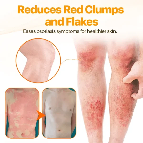 FLYCARE™ Psoriasis Anti-Bacterial Cream