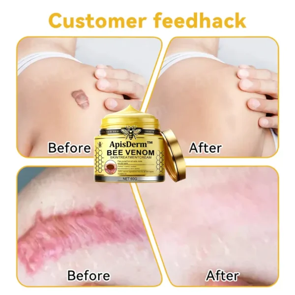 ApisDerm™ Bee Venom Skin Treatment Cream