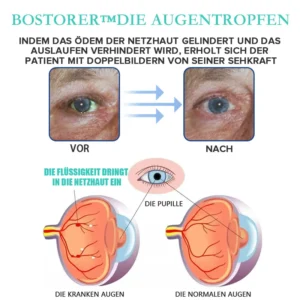 Bostorer™ Augentropfen zur Behandlung von Sehproblemen