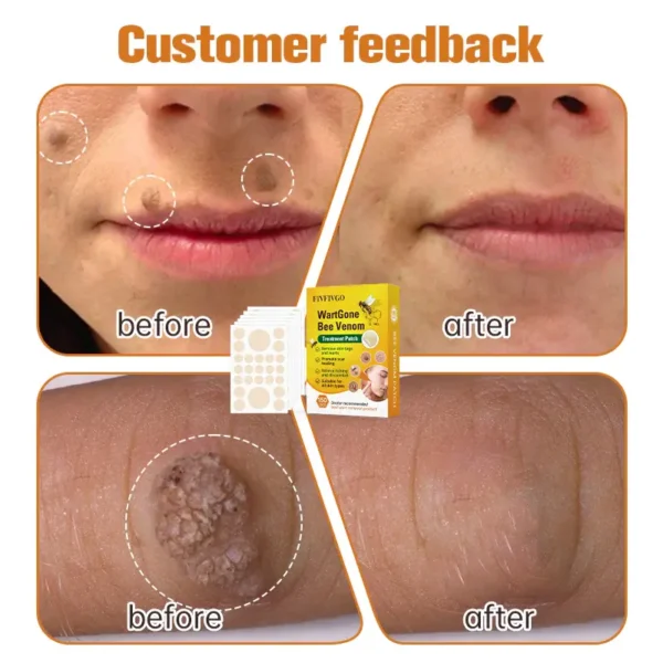 Fivfivgo™ WartGone Bee Venom Treatment Patch - Image 2